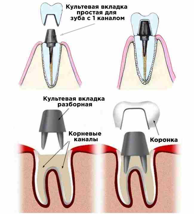 Коронка на зуб