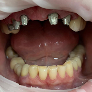 Зубные протезы в Омске по доступной цене и гарантией в клинике Харизма