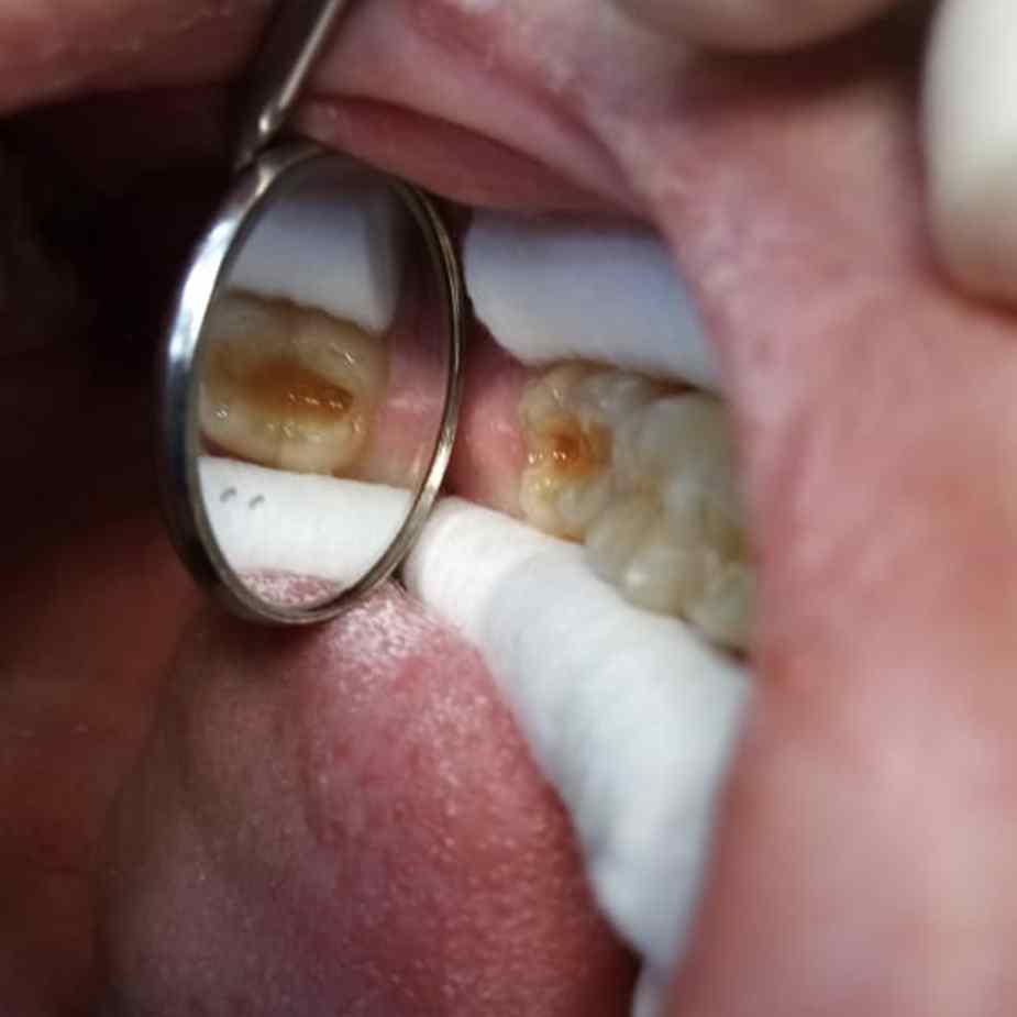 Реставрация жевательных зубов по доступной цене в Омске в клинике Харизма недорого 