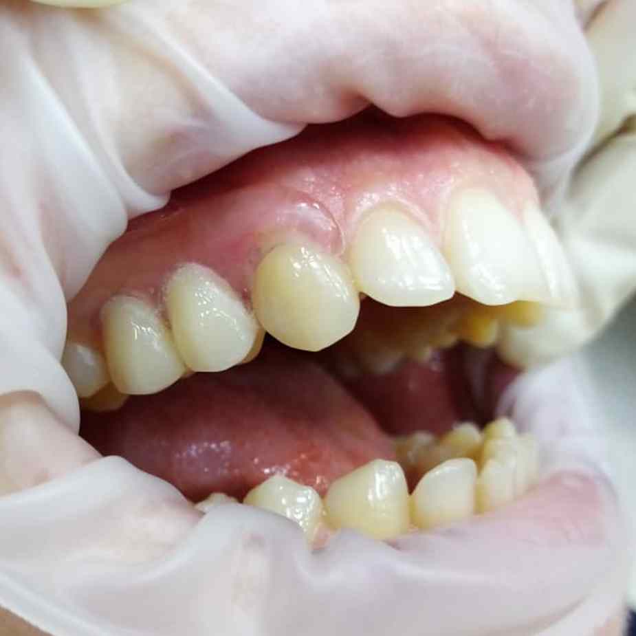 Полный съемный зубной протез в Омске по доступной цене качественно и в срок