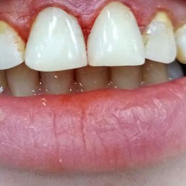 Наращивание зубов в Омске по доступной цене в клинике Харизма недорого 